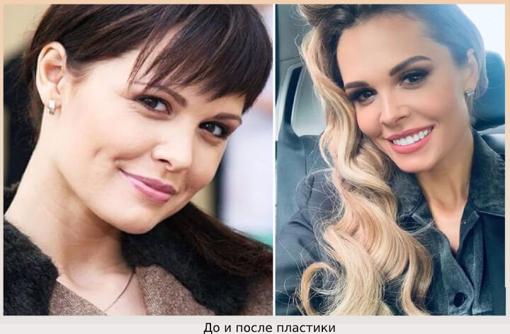 Мария до и после пластики